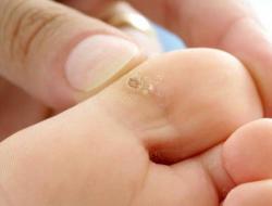 Remedies for the treatment of dry calluses on the feet and fingers